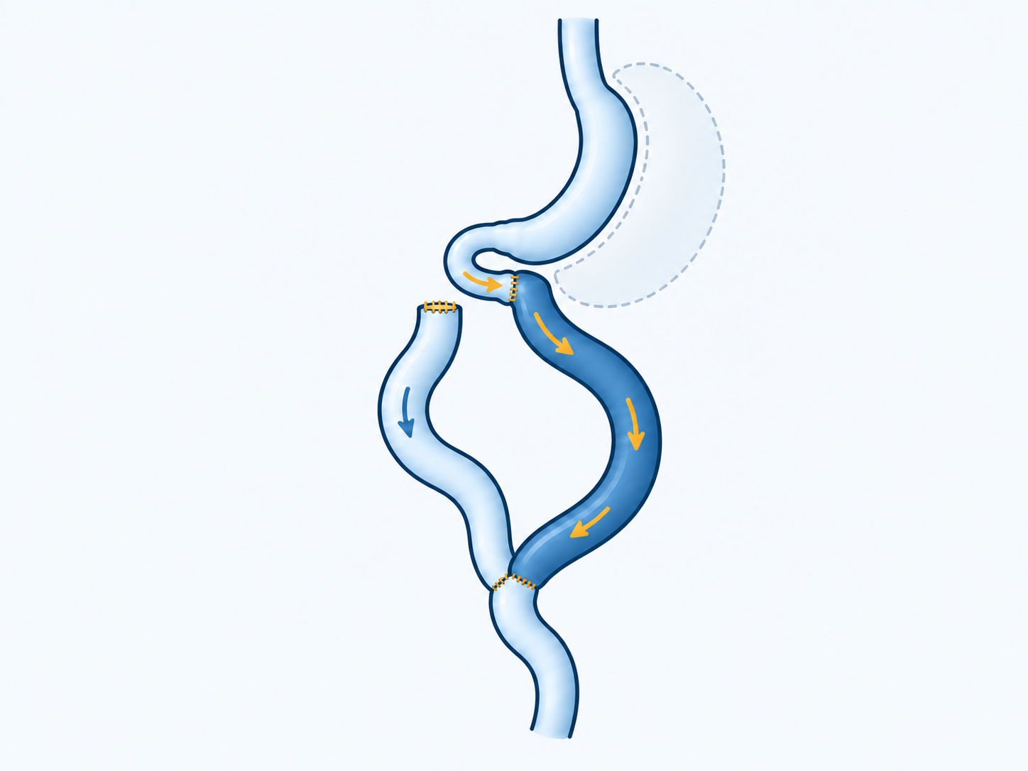 A sleeve connects through a short duodenal segment to a teal food limb; a pale digestive-fluid limb joins at a lower Y connection.