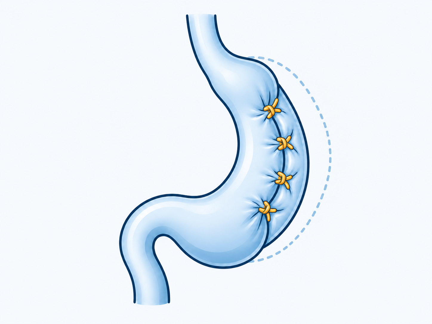An intact stomach drawn narrower by a series of gold sutures and inward folds.