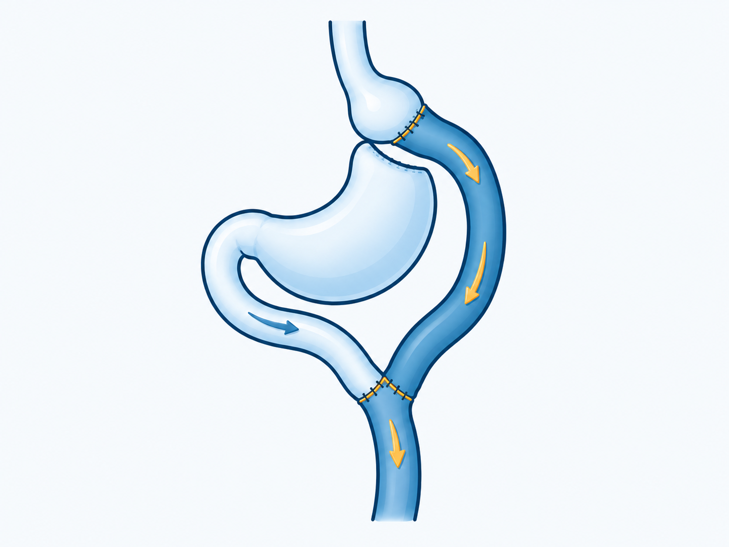 A small stomach pouch connects to a teal food limb; the excluded stomach drains into a separate pale limb joining lower down in a Y.