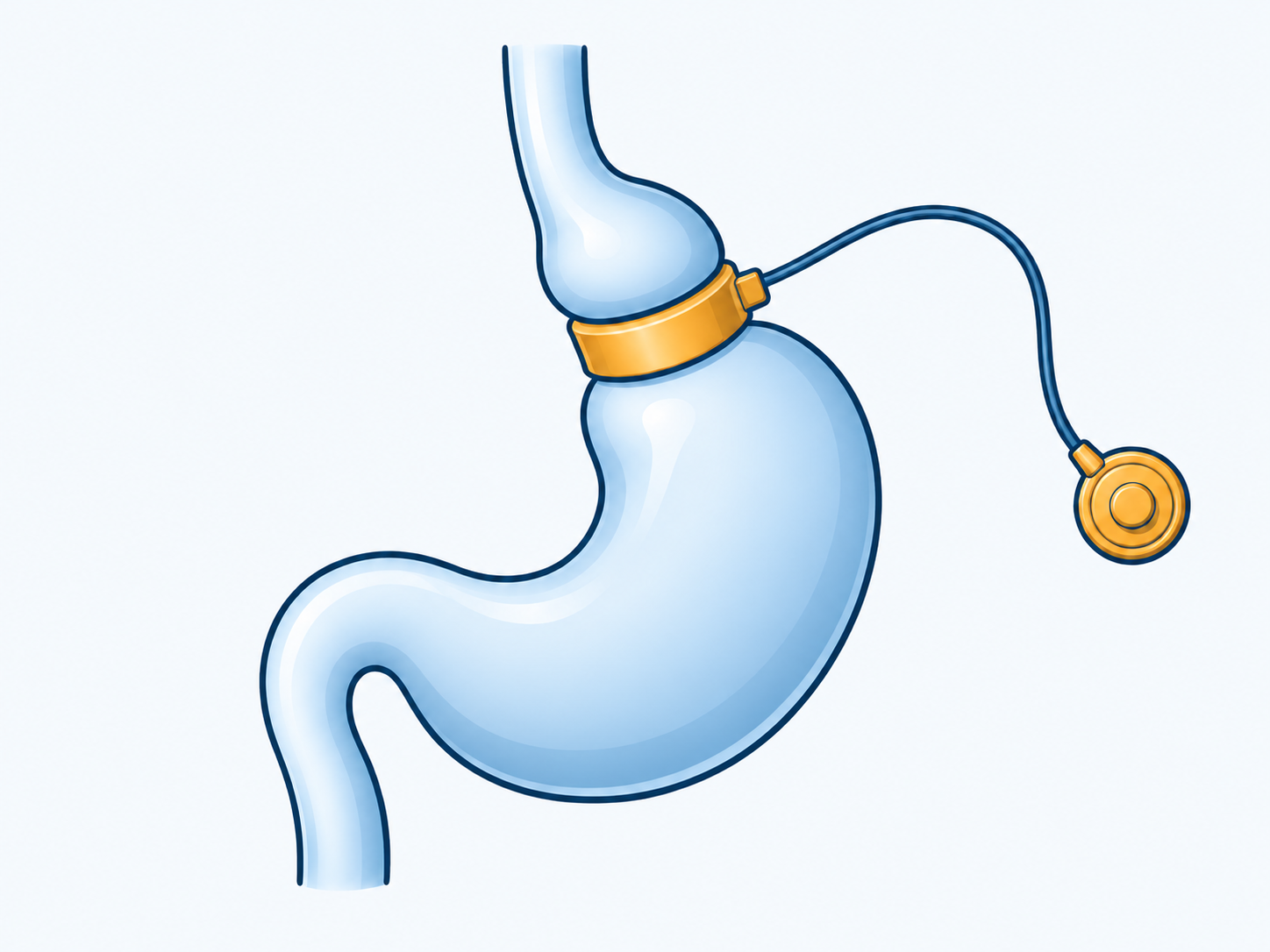 A gold band around the upper stomach connects by a thin tube to an adjustment port.