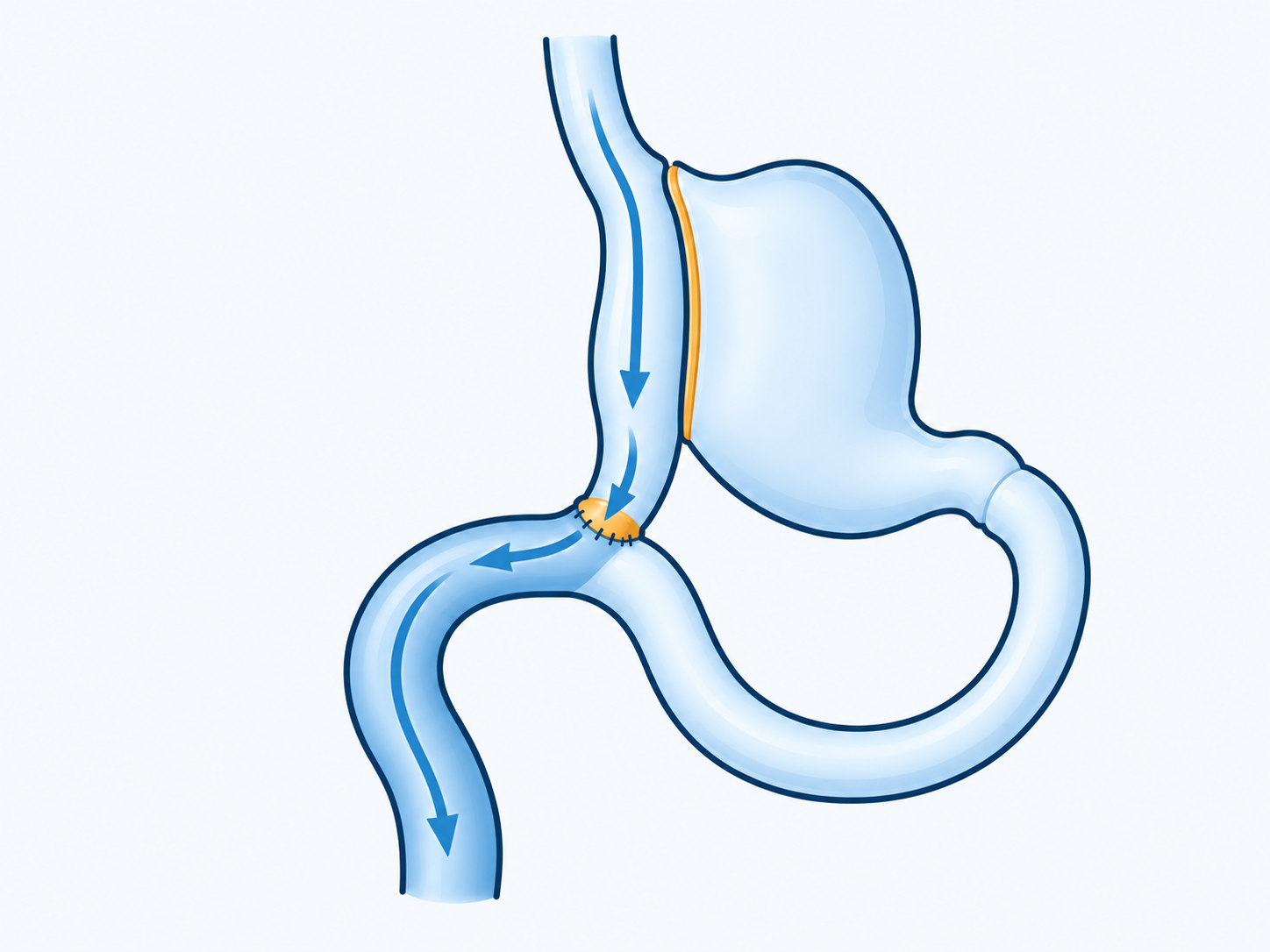 A narrow stomach pouch connects to the side of an intestinal loop, with the excluded stomach shown alongside.