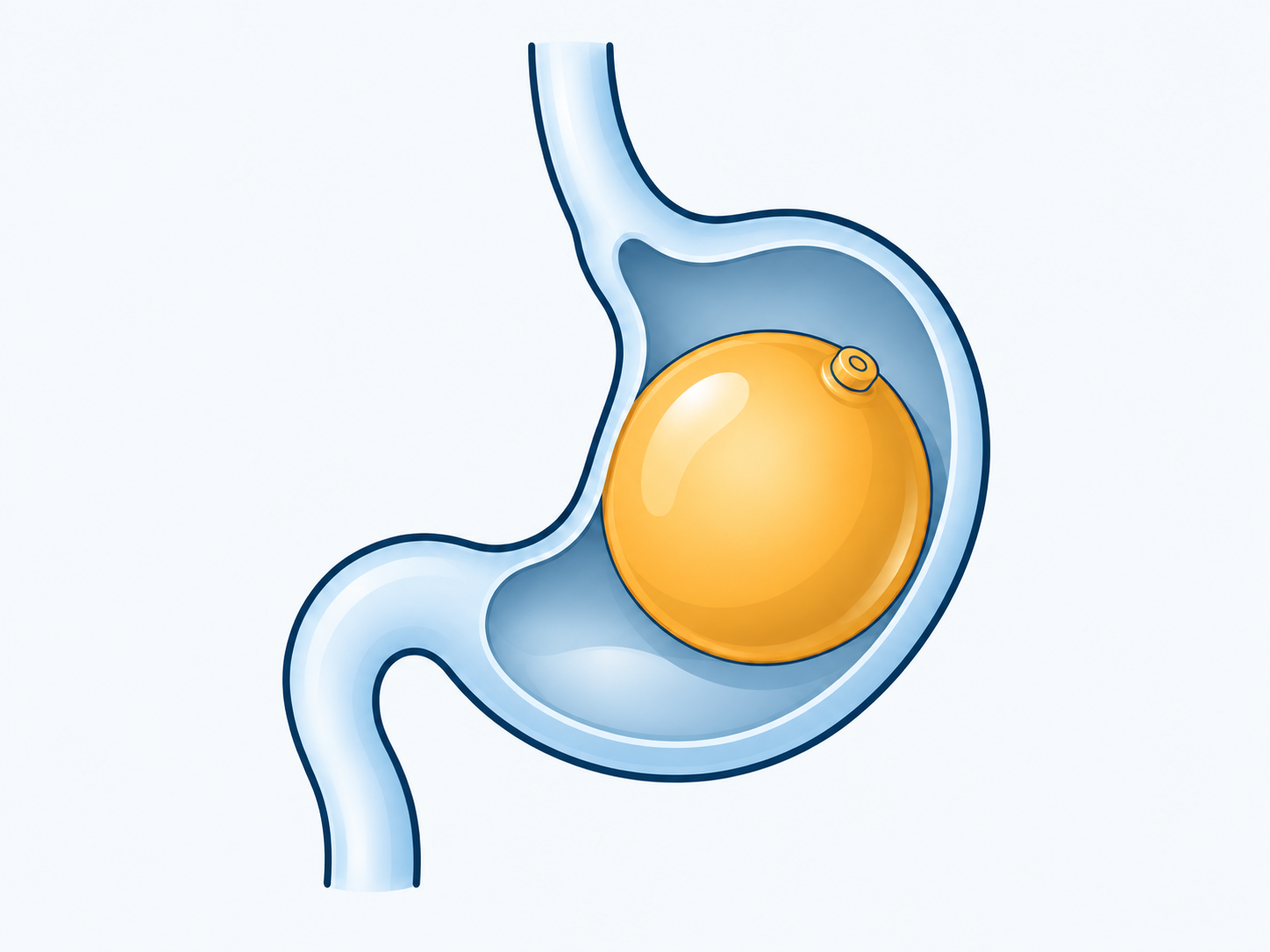 Cutaway stomach containing a single gold balloon, with the stomach wall and outlet intact.