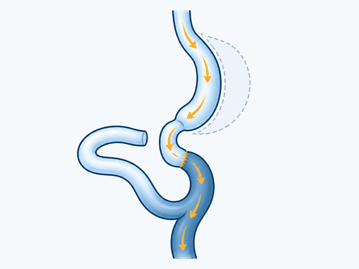A sleeve and preserved stomach outlet connect to a distal intestinal loop; the bypassed segment is shown separately.