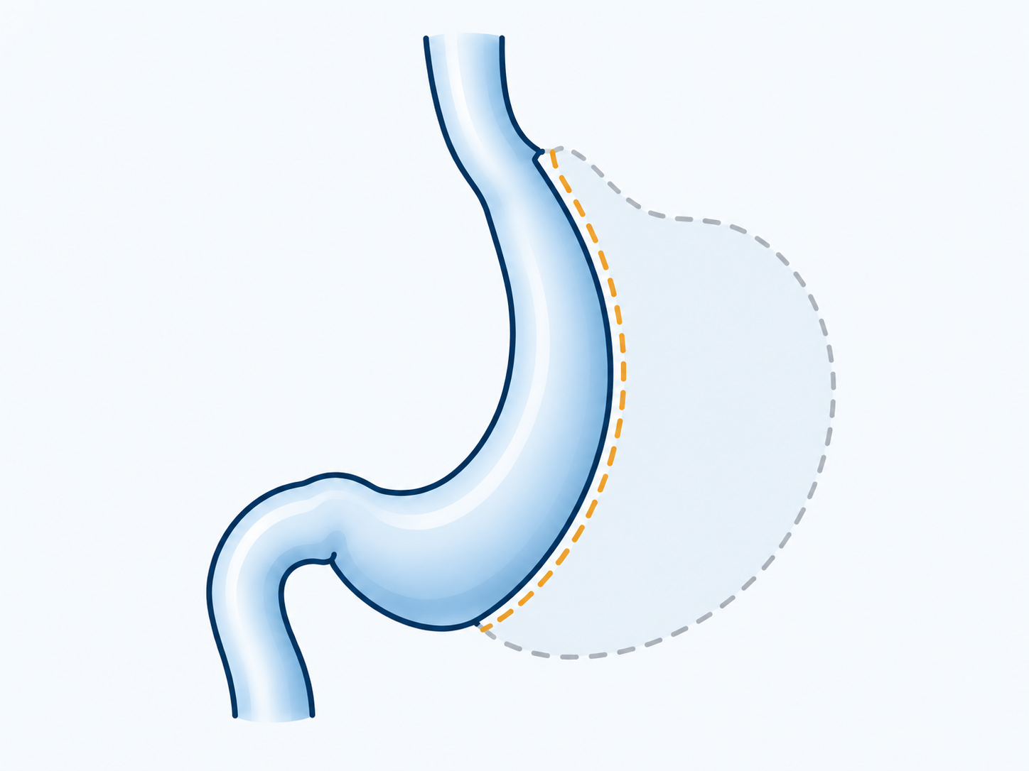 A narrow mint stomach sleeve beside a pale dashed outline of the removed outer stomach.