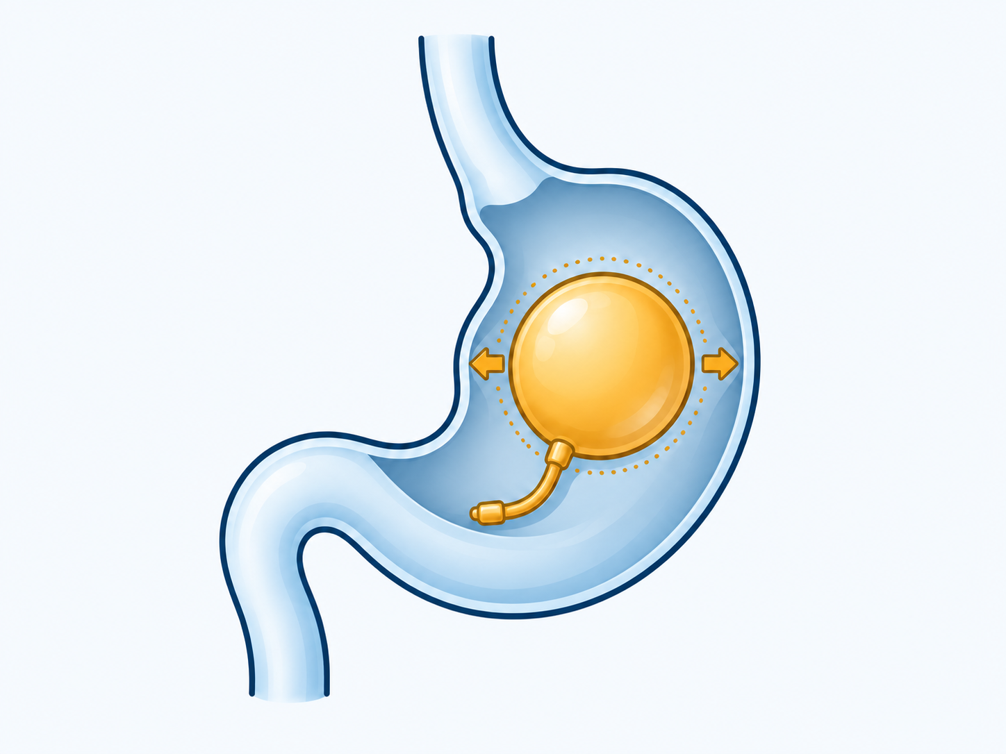 A balloon within the stomach with a short internal adjustment tail and arrows indicating a change in volume.